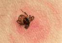 Lyme disease is rare but cases have been recorded across England including in the south west