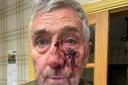 Alan Cummings was injured after a confrontation with three men riding mountain bikes near Cropton Forest