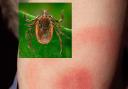 Ticks and Lyme disease